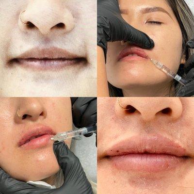 Proper technique to giving injections minimizes complications