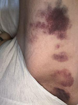 This is only one side of my leg only .