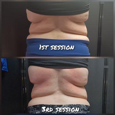 Full 360° Package (Stomach & Back)