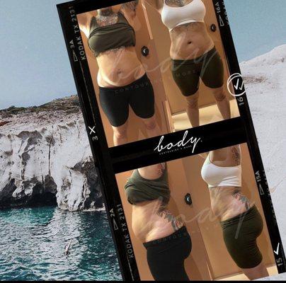 Clients Results of 2 Sessions of Cavitation & Radio Frequency.