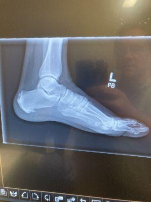 Heel Spur, Achilles Spur