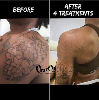 Clear Out Ink Laser Tattoo Removal
