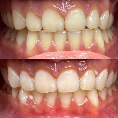 Before and After Whitening