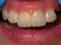 Dr. Rathjen was able to "cap" this single tooth and make it look like two. Note the pink porcelain at the gumline.