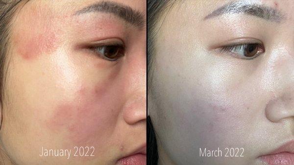 Facial Eczema 3 Months Healing Progress - Acupuncture by Dr. Lorena Lee