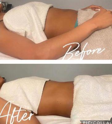 Beautiful Results of the Abdomen , Lymphatic detox