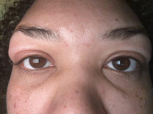 after the lashes were removed and I had eye drops & ointment & Benadryl it was worse than this My eyes were red burning itching and painful
