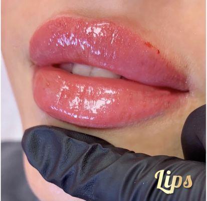 Lips filler with Juvederm ultra