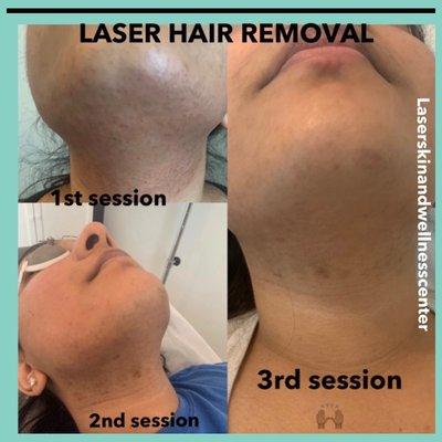 laser hair removal just 3 sessions.