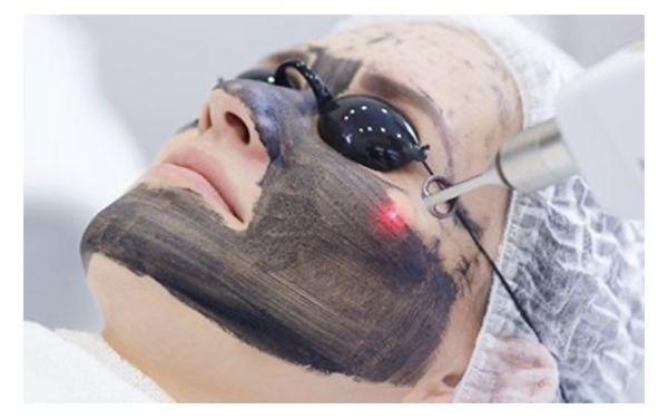 Carbon Peel facial laser treatment.