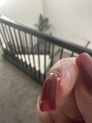 They cut my finger with a nail file
