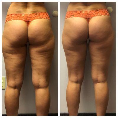Before and after 8 visits of endermologie