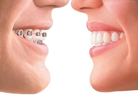 Braces & Invisalign offered