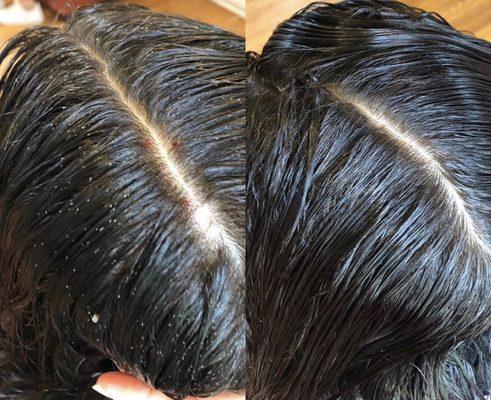 Before & After Lice Removal