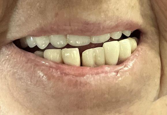 Finished product. They can't fix this "to suit me". This is absolutely ridiculous. The teeth looked 100 times better before this.