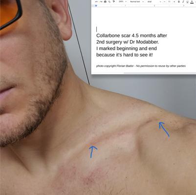 4.5 months after 2nd surgery w/ Dr Modabber.
@Florian Bador