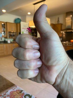 This hand was crushed with compound fractures and it's back to 90%+ function. I'm really happy with the care and results!