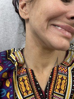 This is my face caved in even after fixed teeth from excessive alvolplasty. I did not consent cause I already had too much bone loss