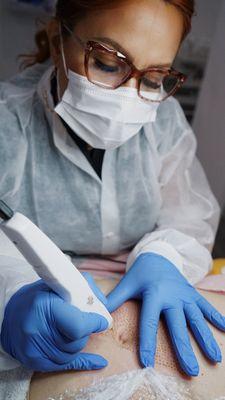 Plasma Fibroblast on the abdomen. Procedure done to tighten skin.