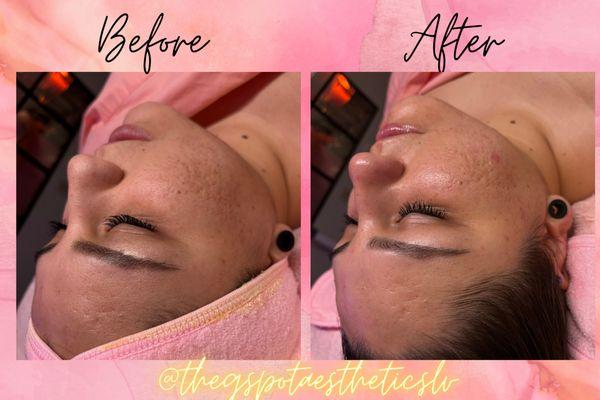 Deluxe Facial w/ dermaplane & microdermabrasion