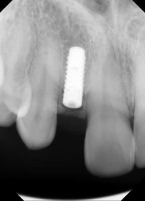 3.3 mm Straumann Implant, Basel Switzerland; placed by North Berkeley Periodontics