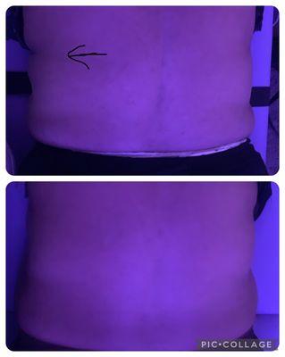 Back Body Sculpting Non-Invasive lase lipo Pain Free