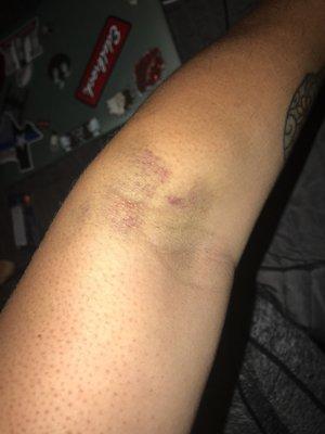 And she still missed my huge veins 