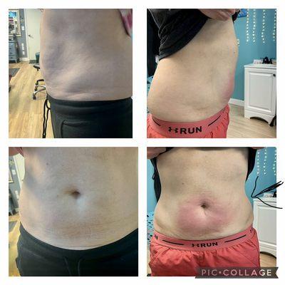 Before after cryoskin 3 treatments