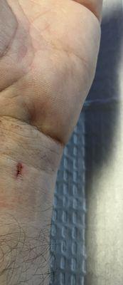 Follow up. 3 days later. Just the tiny incision.