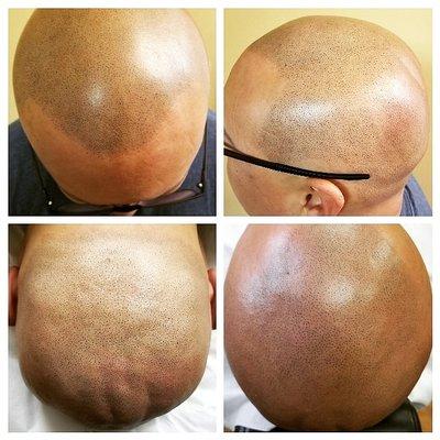 This young man struggled with Alopecia since he was a boy. He has finally found confidence and freedom through Scalp Micropigmentation!