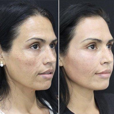 Before & After Botox / Filler / Skincare