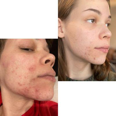 Before my first treatment (the left) and this was on a good day To After my first treatment (the immediate difference )