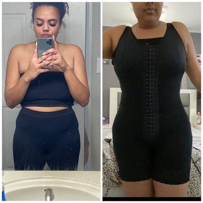 360 lipo with fat transfer