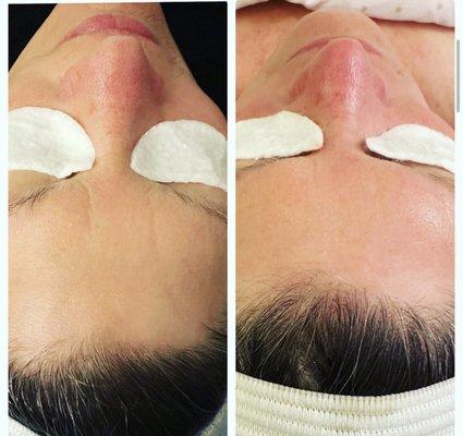 11 wrinkles reduction