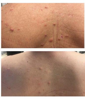 My back after just 2 session of a peel to remove keloid scarring