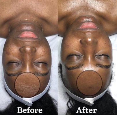 Results after 1 Anti Aging Facial