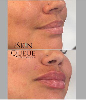 lip filler, before and after