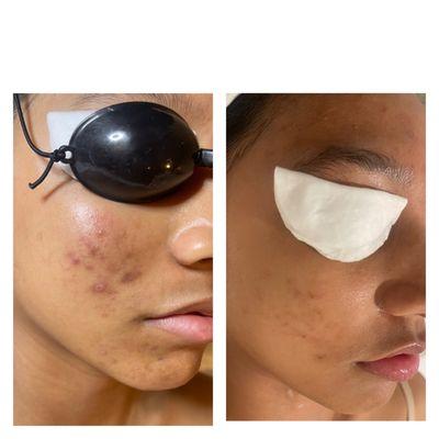 Acne Clearing Facial With Red Light