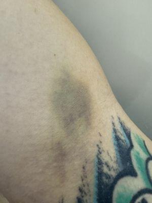 Bruising from phlebotomist draw on Monday - today is Friday.