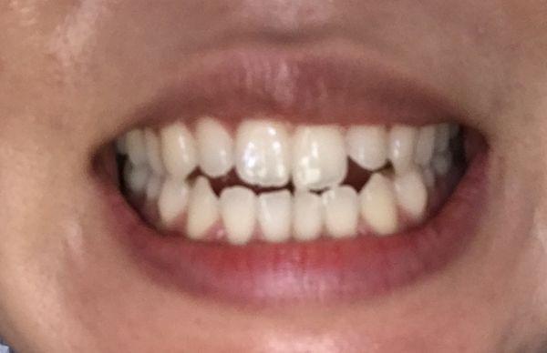 BEFORE: open bite, not straight, couldn't bite down on a sandwich