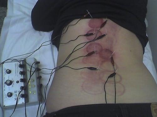 After cupping I got accupuncture with electrical impulses.