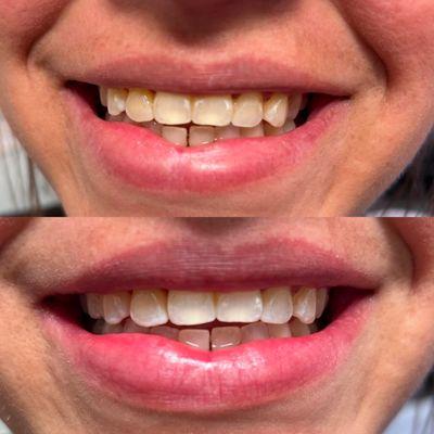 30 Minute teeth whitening it's amazing