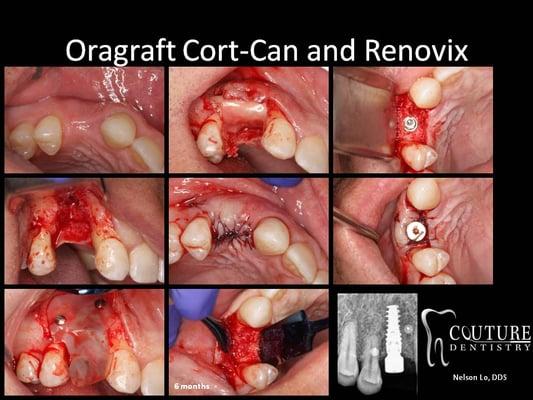 Bone Grafting and Dental Implant placed by Dr. Nelson Lo.