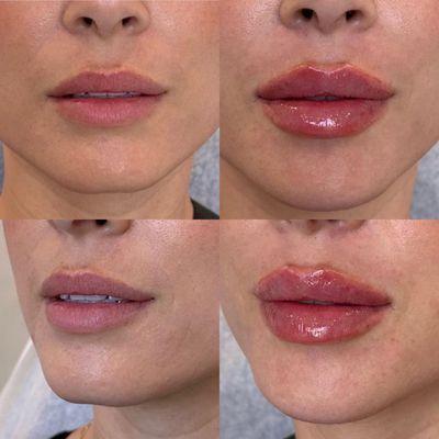Lip Filler