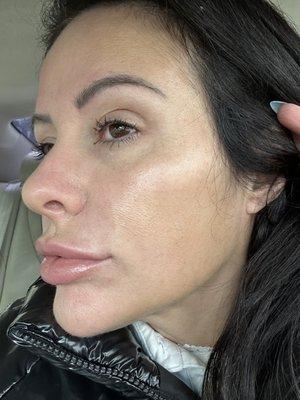 This is right after the lip injection. First day.