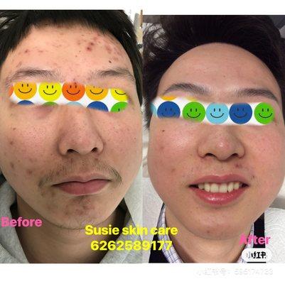 Stop acne and remove scar