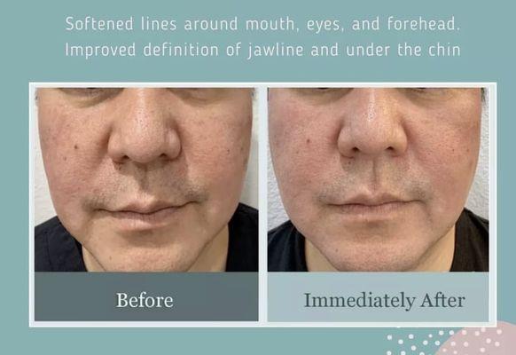 THERMAGE skin tightening