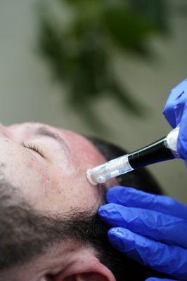 Microneedling stimulates collagen and elastin. Improves skin texture, reduces fine lines, wrinkles, acne scars, and other imperfections.