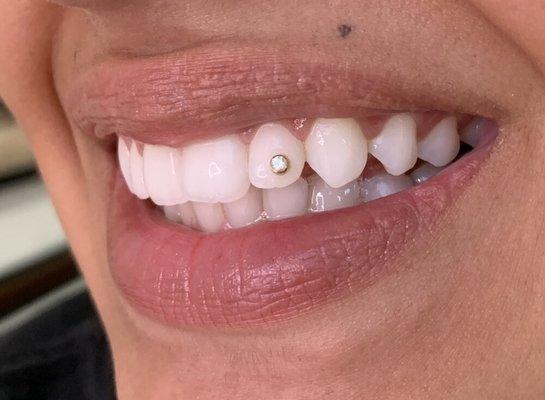 Teeth gems
