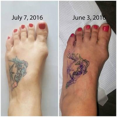 This patient LOVES her high heels but was concerned about her bunion growing. One month into our reflexology sessions. What a difference!